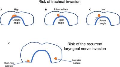 Early Diagnosis of Low-Risk Papillary Thyroid Cancer Results Rather in Overtreatment Than a Better Survival